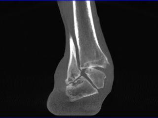 ankle arthritis