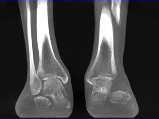 calcaneo fibular impingement