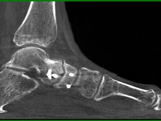 Talar navicular non union sagittal